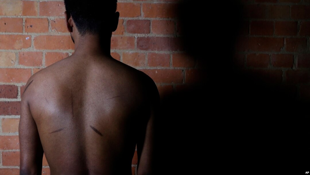 FILE - A Sri Lankan man known as Witness #205 shows the scars on his back during an interview in London, July 20, 2017.