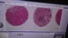 Scientists at the University of Southern California in Los Angeles are developing a way of using machine learning to identify specific types of breast cancer tumors, and they say it's just the beginning of what the computer can do.