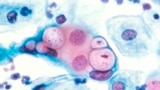 Cervical Cancer