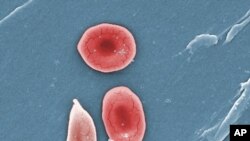 Imagen de microscopio coloreada de 2009 puesta a disposición por la Fundación de células falciformes de Georgia muestra una célula falciforme.