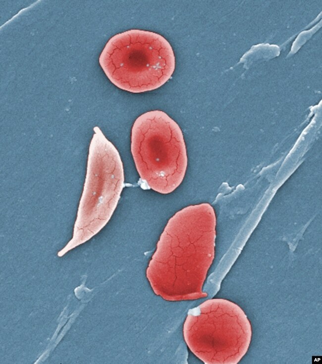 This 2009 colorized microscope image made available by the Sickle Cell Foundation of Georgia via the Centers for Disease Control and Prevention shows a sickle cell, left, and normal red blood cells of a patient with sickle cell anemia.