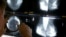 FILE - A radiologist uses a magnifying glass to check mammograms for breast cancer in Los Angeles, California, May 6, 2010.