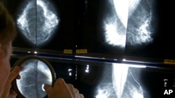 FILE - A radiologist uses a magnifying glass to check mammograms for breast cancer in Los Angeles, California, May 6, 2010.