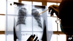 FILE - A doctor examines chest X-rays at a tuberculosis clinic in Gugulethu, Cape Town, South Africa, Jan. 17, 2014. 