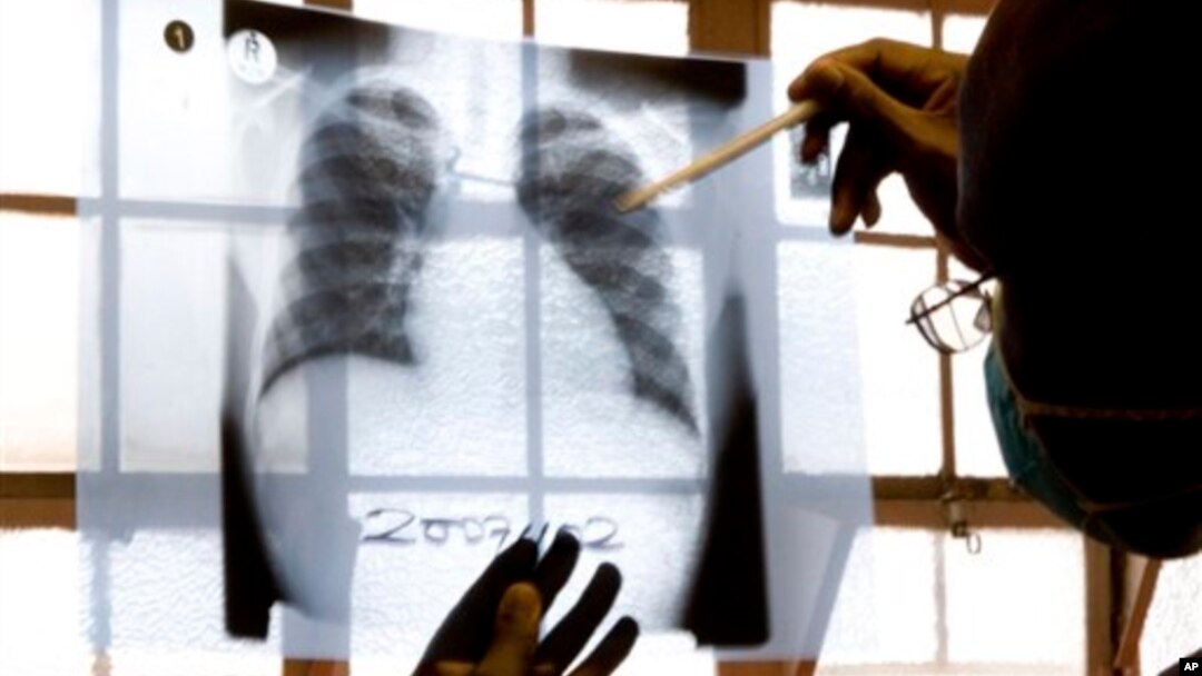 FILE - A doctor examines chest X-rays at a tuberculosis clinic in Gugulethu, Cape Town, South Africa.