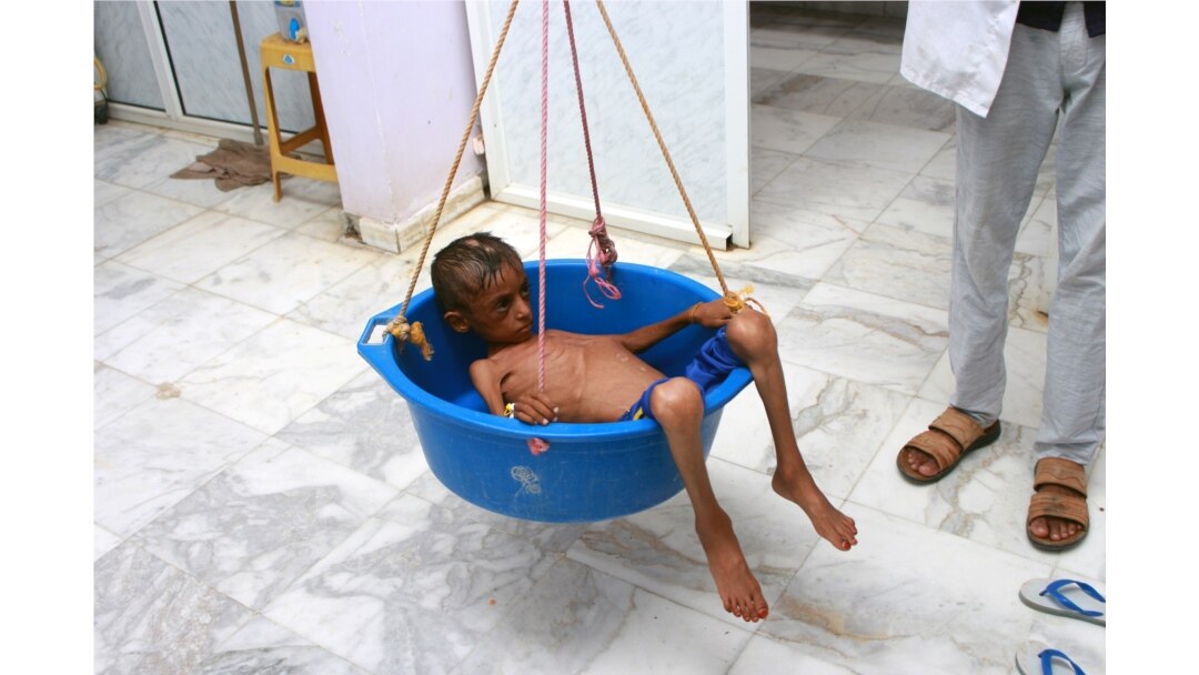 A doctor weighs malnourished boy Hassan Merzam Muhammad at a hospital in Aslam district of Hajjah province, Yemen, July 18, 2020.