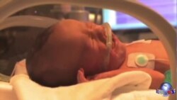 美国单羊膜双胞胎顺利出生