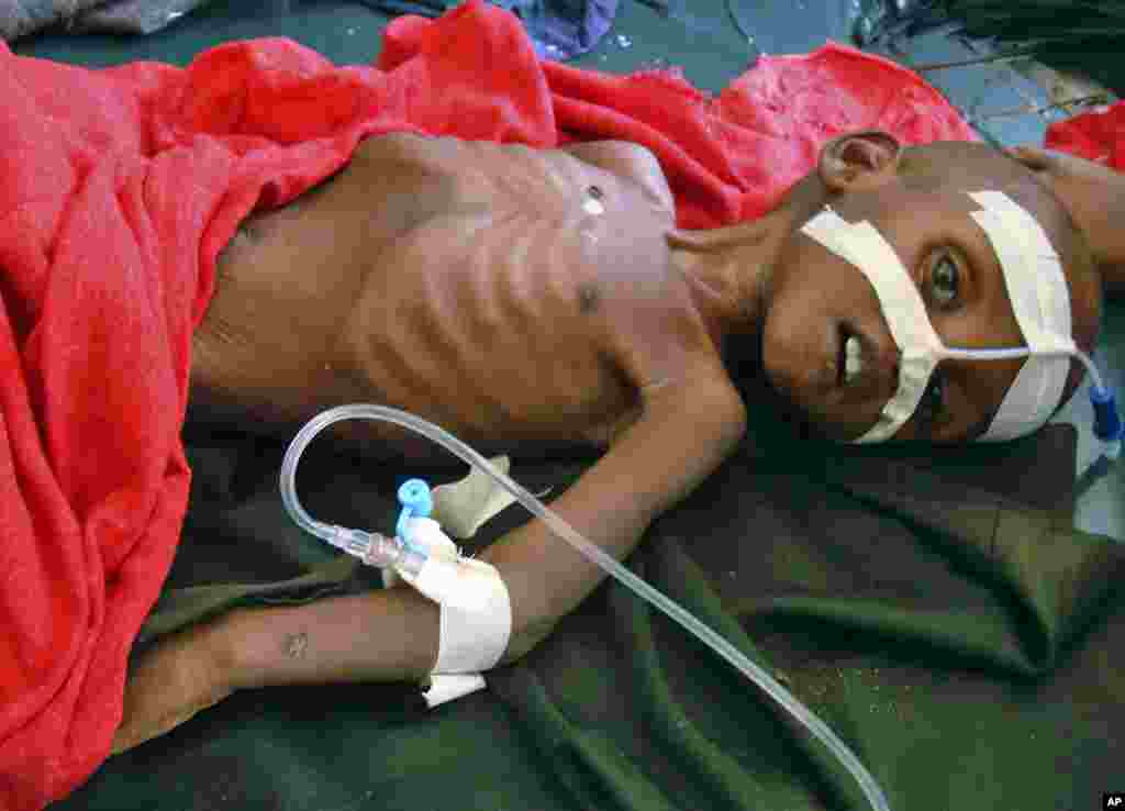 来自索马里南部的名叫阿布迪里萨卡.穆尔萨尔的三岁小孩在摩加迪沙的班纳迪尔医院接受治疗。这孩子患有营养不良症。