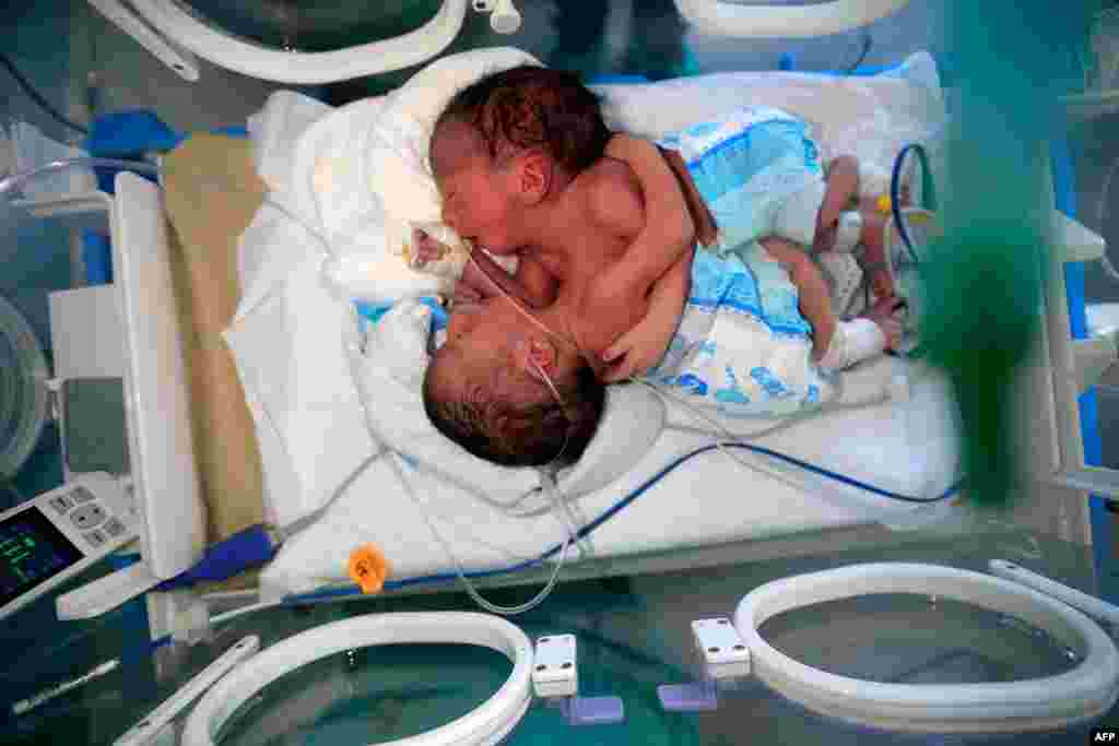 Newborn conjoined twins lie in an incubator at the child intensive care unit of al-Sabeen hospital in Yemen&#39;s capital Sanaa. The boys, born in war-ravaged Yemen, are in critical condition and in need of treatment abroad, according to the hospital.