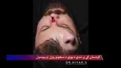 کردستان کې پر تندي د پوزې د نسجونو روزل او پیوندول