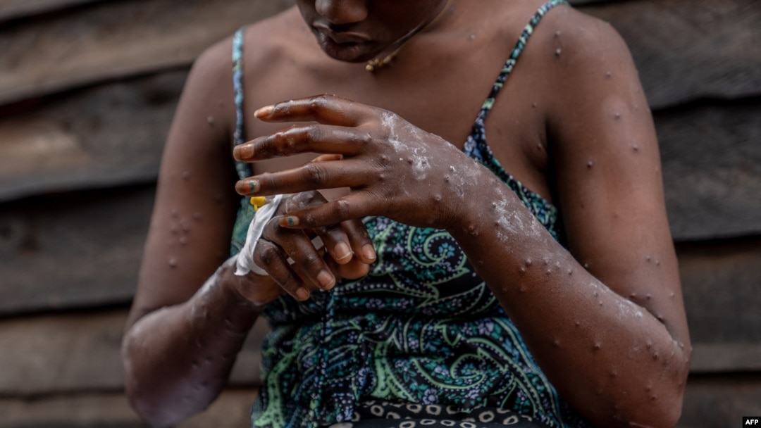 Paciente com Mpox na República Democrática do Congo, 24 agosto 2024