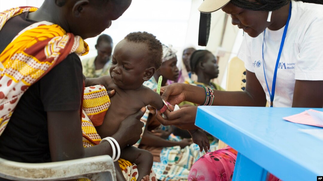 FILE - In this photo of Friday, July 25, 2014, a child with suspected malnutrition is examined at IMC nutrition program clinic in Malakal, South Sudan. 