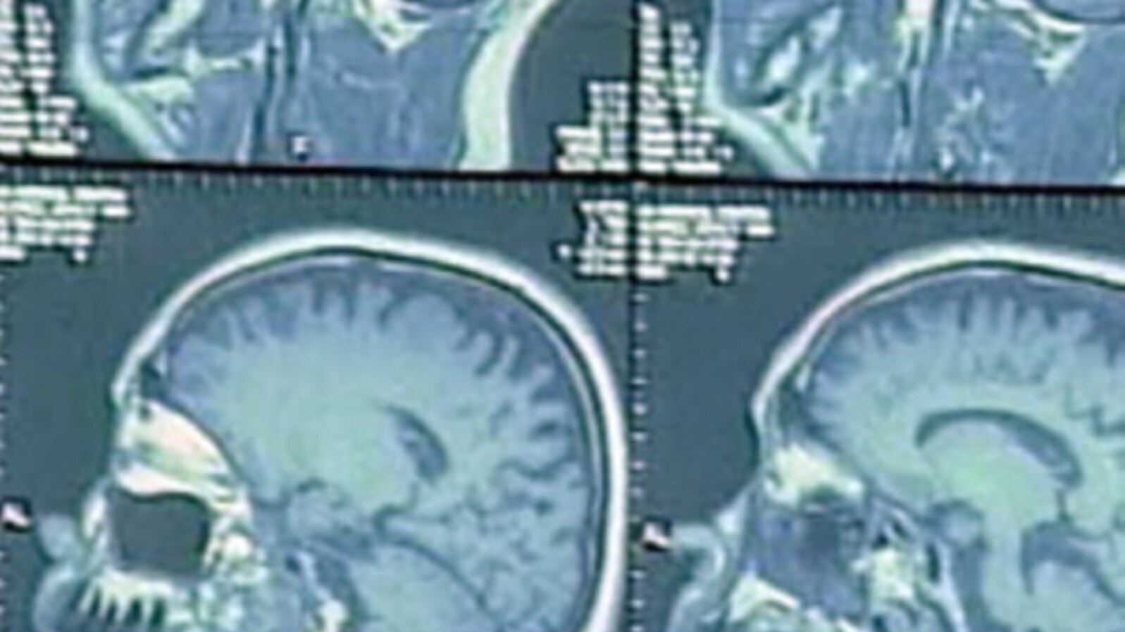 Study: Early Diagnosis of Alzheimer's Better for Patients and Caregivers