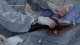 Новина за хирурзите - операциите врз срце стануват попрецизни со 3Д модели