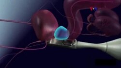 Nueva técnica no invasiva para cáncer de próstata