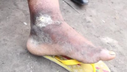 Bokono bwa mbasu to "Ulcère de Buruli"