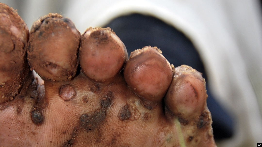 A resident of Kamuli district in eastern Uganda, displays her foot, infested by jiggers. (File Photo)