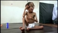 یمن میں غذائی قلت سے لاکھوں زندگیوں کو خطرہ