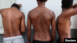 Ethiopian citizens who were trafficked into working at scam centers in Myanmar and were sent to Thailand on Feb. 12 show injuries from torture by electric shocks and punches when they could not reach assigned targets, at a shelter in Tak province, Thailand Feb. 19, 2025.