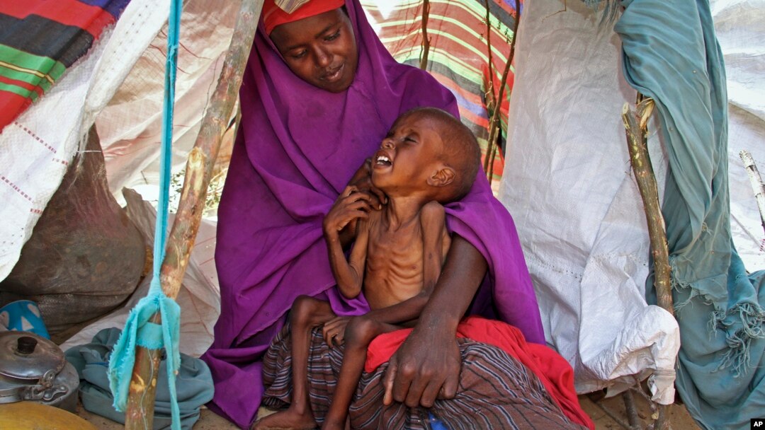 FILE - A displaced Somali mother comforts her malnourished child in their makeshift shelter at a camp in the Garasbaley area on the outskirts of Mogadishu, Somalia, March 28, 2017.