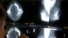 Radiolog koristi lupu kako bi provjerio mamografe za rak dojke u Los Angelesu 6. maja 2010.