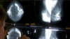 Seorang ahli radiologi menggunakan kaca pembesar untuk memeriksa mammogram guna mengetahui adanya kanker payudara di Los Angeles pada 6 Mei 2010. (Foto: AP)