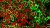 تصویری از سلول‌های سرطانی - آرشیو