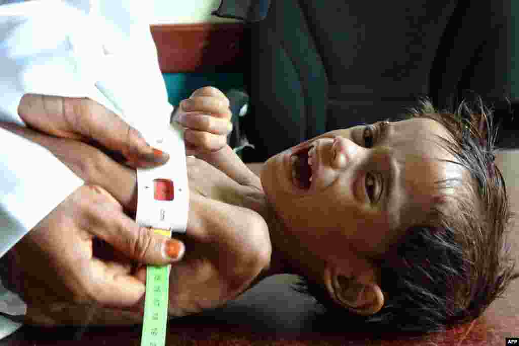Ahmed Abdo Salem, a two-year-old Yemeni child displaced by conflict suffering from malnutrition is measured at a health clinic in the war-ravaged western Hodeida province.