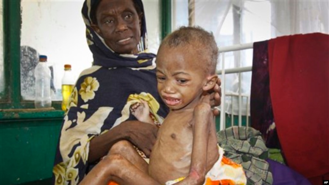 Seorang balita yang menderita kurang gizi dirawat di rumah sakit Mogadishu, Somalia (foto: dok). Sekitar 3 juta warga Somalia menderita kekurangan pangan akibat kekeringan.