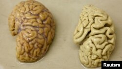 FILE - One hemisphere of a healthy brain (L) is pictured next to one hemisphere of a brain of a person suffering from Alzheimer disease.