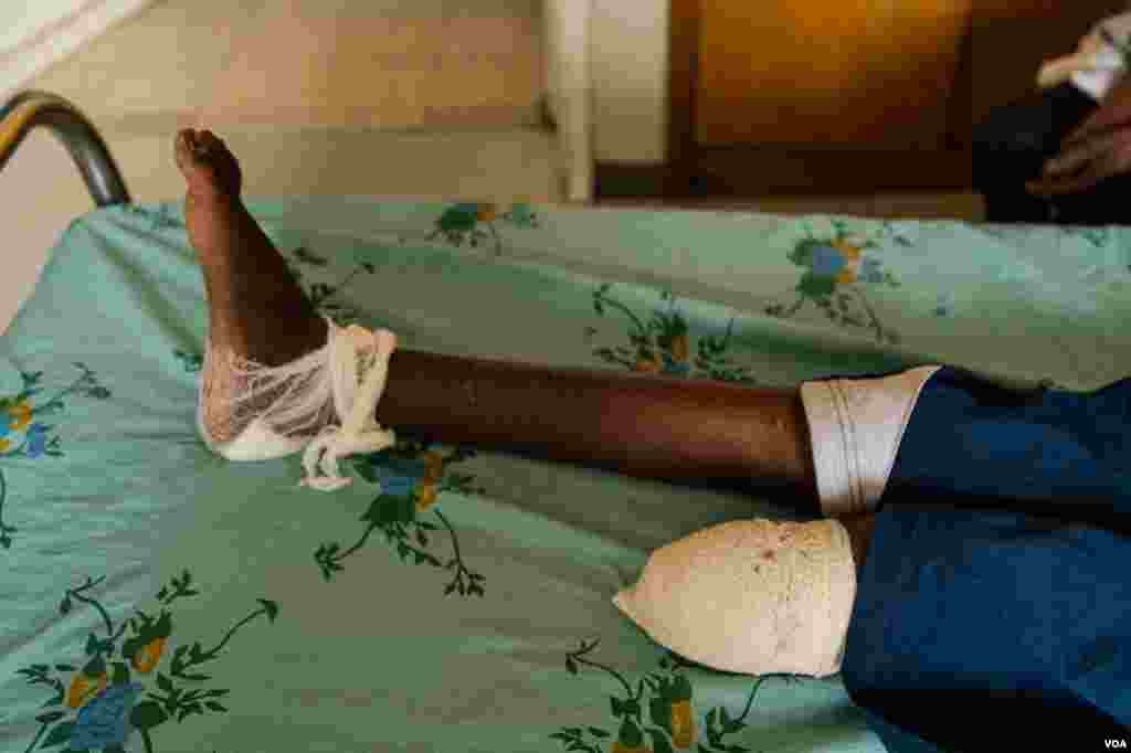 A patient rests in a Mekelle, Ethiopia, hospital on June 4, 2021. Children and teenagers are among the victims who have lost limbs in the Tigray conflict.