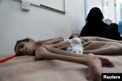 FILE - Faid Samim, 7, a malnourished boy who also has cerebral palsy, lies on a bed at the malnutrition treatment ward of al-Sabeen hospital in Sana'a, Yemen, Dec. 28, 2020.