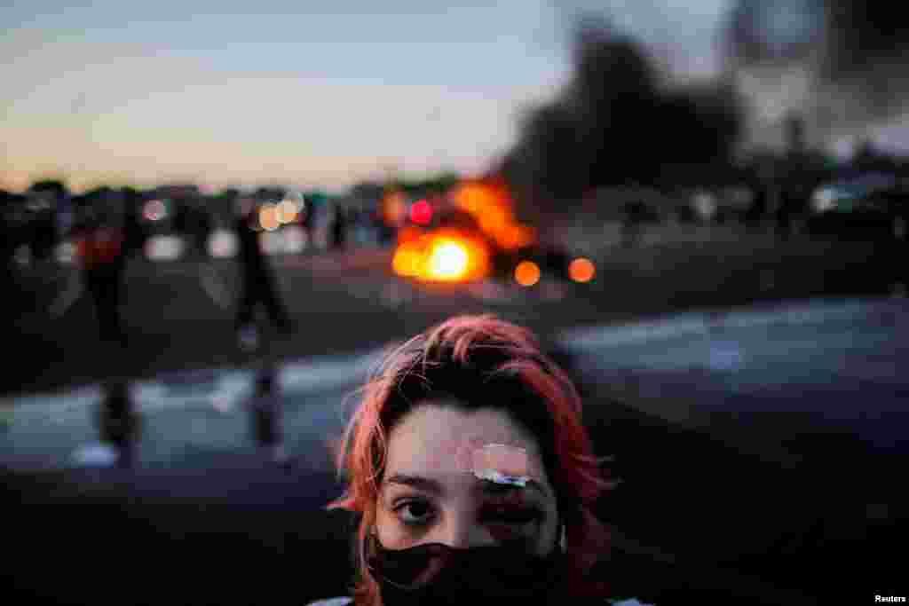 Rachel Perez is pictured with bruising around her eye and a plaster on her forehead, injuries sustained from rubber bullets during protests May 26,2020, while standing a distance from a burning vehicle.