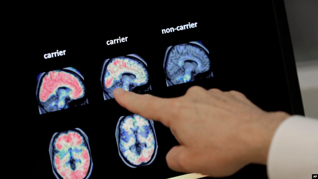 Seorang dokter menunjuk foto PET scan otak di Banner Alzheimers Institute di Phoenix, 14 Agustus 2018.