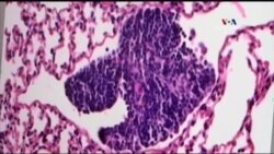 Քաղցկեղից բուժման բեկումնային հայտնագործություն