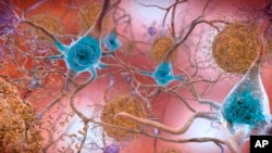 This illustration made available by the National Institute on Aging/National Institutes of Health depicts cells in an Alzheimer’s affected brain, with abnormal levels of the beta-amyloid protein clumping together to form plaques, brown, that collect between neurons and disrupt cell function. (National Institute on Aging, NIH via AP)