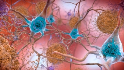 Quiz - Another Alzheimer's Drug Showing Promise