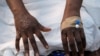 FILE PHOTO: The hands of a patient with skin rashes caused by the mpox virus are pictured in Kinshasa