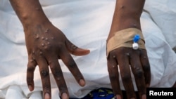 FILE PHOTO: The hands of a patient with skin rashes caused by the mpox virus are pictured in Kinshasa