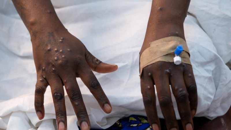 En RDC, des malades atteints du Mpox ont fui l'hôpital de Goma, selon l'OMS