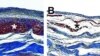 Microscopic images of pig hearts damaged by heart attack show the growth of new heart muscle tissue (shown in red, Figure A) after treatment with an injectable hydrogel compared to a heart left untreated (Figure B, right). Image Credit: Karen Christman, UC San Diego Jacobs School of Engineering. 