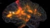 FILE - An image shows activity in a human brain. Scientists have developed a drug capable of sweeping away abnormal protein clumps in the brain which are a hallmark of Alzheimer’s disease.