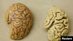 One hemisphere of a healthy brain (L) is pictured next to one hemisphere of a brain of a person suffering from Alzheimer disease. (File Photo)