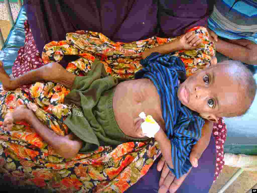 A severely malnourished displaced Somali child is admitted at southern Mogadishu's Banadir hospital for treatment on August 2, 2011. (AFP)