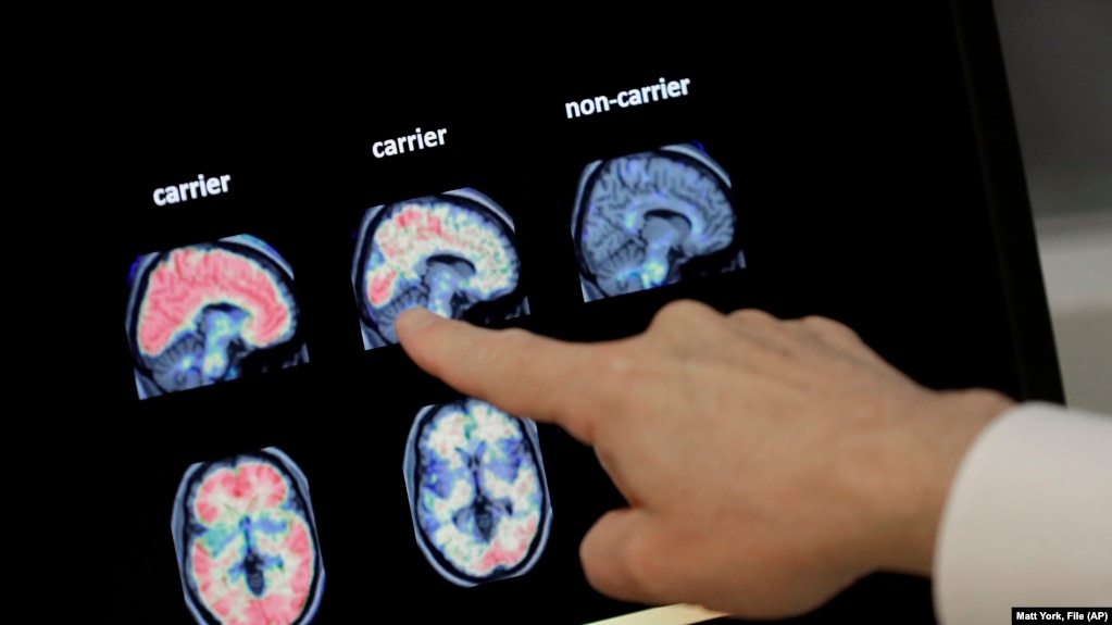 FILE - A doctor looks at PET brain scans at Banner Alzheimers Institute in Phoenix on Aug. 14, 2018. 