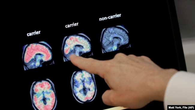 FILE - A doctor looks at PET brain scans at Banner Alzheimers Institute in Phoenix on Aug. 14, 2018. 