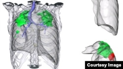 Rendering of a CT scan of a patient with extensively drug-resistant tuberculosis. Credit: Clifton Barry, NIAID