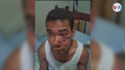 Imagen de Andrés Eloy Bueno tras sufrir quemaduras en su rostro durante una protesta estudiantil en Caracas. Denuncia que unos guardias nacionales lo obligaron a oler gases lacrimógenos, lo que le provocó serios problemas de salud. Foto: Cortesía.