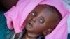 Malnourished five-month old Tiere Pascol lies in his mother's arms at a feeding center in Al Sabah Children's Hospital in Juba, South Sudan Dec. 3, 2020.