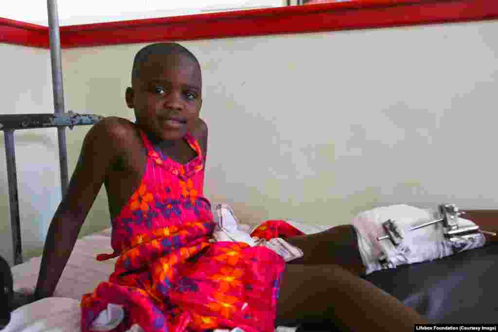 Young girl on the ward at a hospital, leg in traction, recovering from osteotomy [bone cut] to correct bow legs.